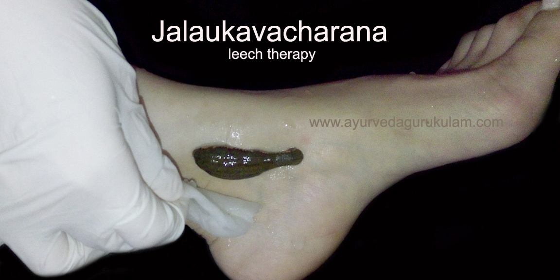 leech therapy